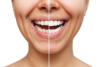 Patient's smile before and after veneers